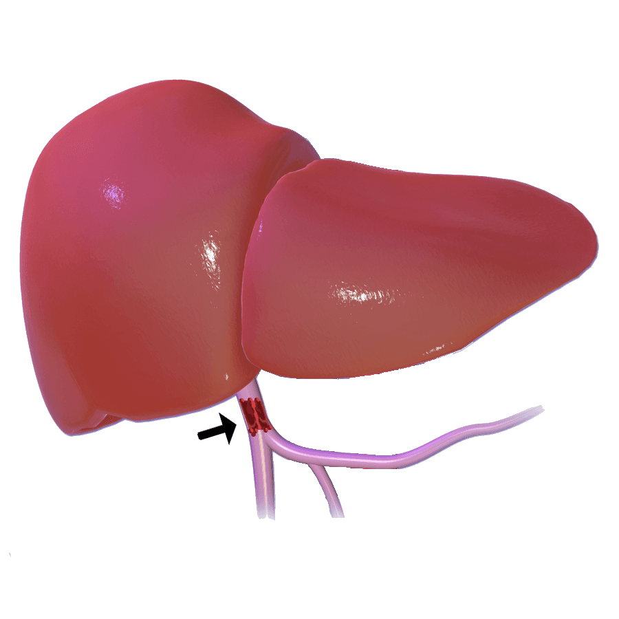 TROMBOSIS ESPLÉNICA